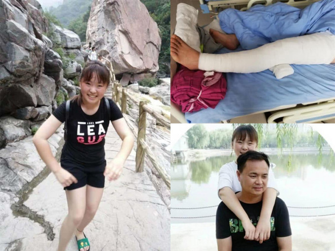 河南新乡17岁全身80％皮肤烧伤。爸爸将左腿上的皮肤整条移植给了她。(网图)