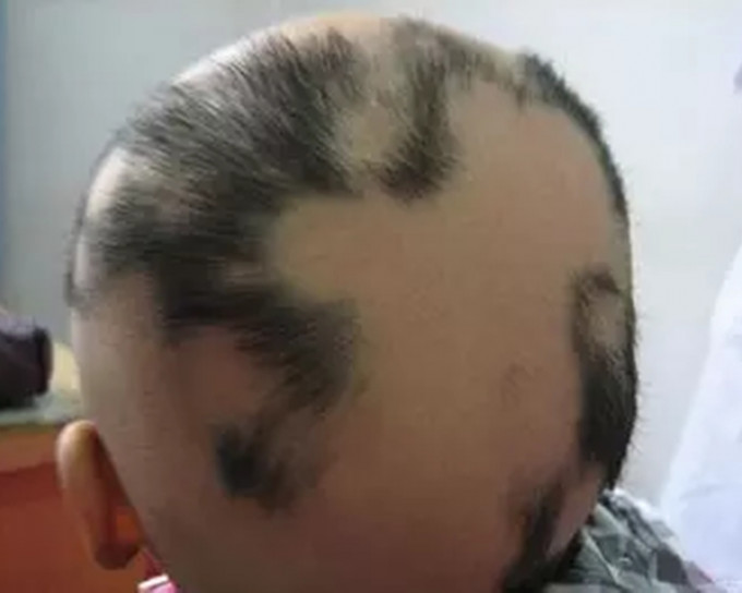 2岁半的东东近日不停掉头发，被诊断为压力性斑秃。网上图片
