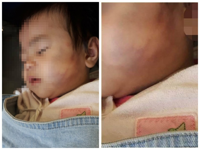 8个月女婴脸遭掴至全瘀青。fb　