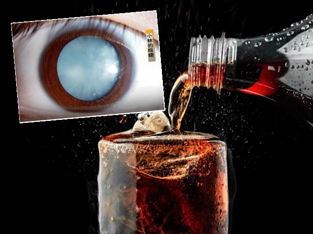 小林長期可樂當水飲，以致右眼瞳孔變成淡藍色，接近完全失明。網圖