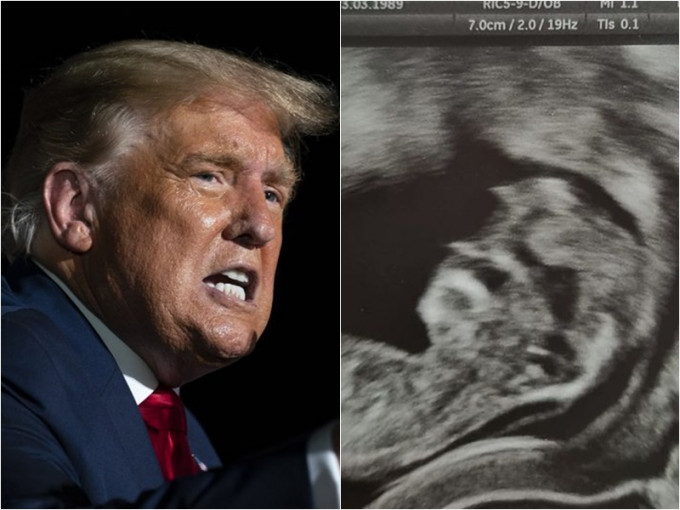 英國一名孕婦分享胎兒超音波照，覺得側面似特朗普。