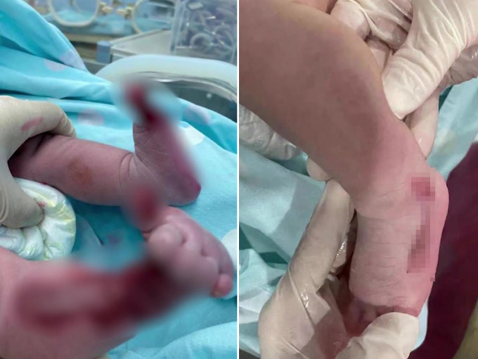 深圳一名初生嬰先天性皮膚發育不全，露出肌肉。