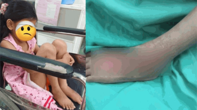 网民爆料附上受害女童伤势照片。 X