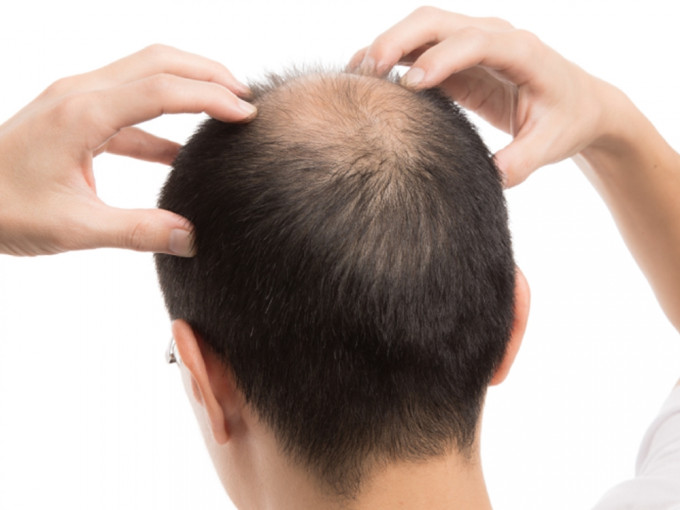醫生提醒，頭頂、頭髮比較稀疏的人，踏入秋天仍要小心避免頭皮被曬傷。網圖
