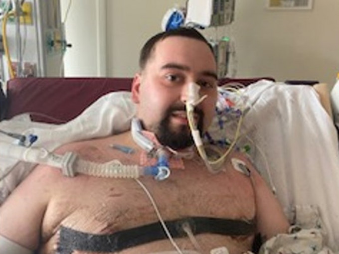 美國24歲男子Blaze拒打新冠疫苗後卻不幸染疫，須接受雙肺移植手術以保命。網圖