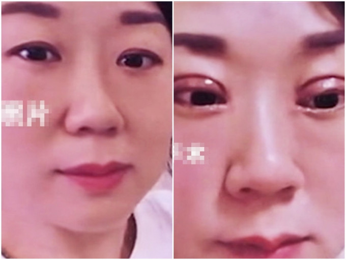 江西一名人妻進行割雙眼皮手術，怎料卻手術失敗。網圖