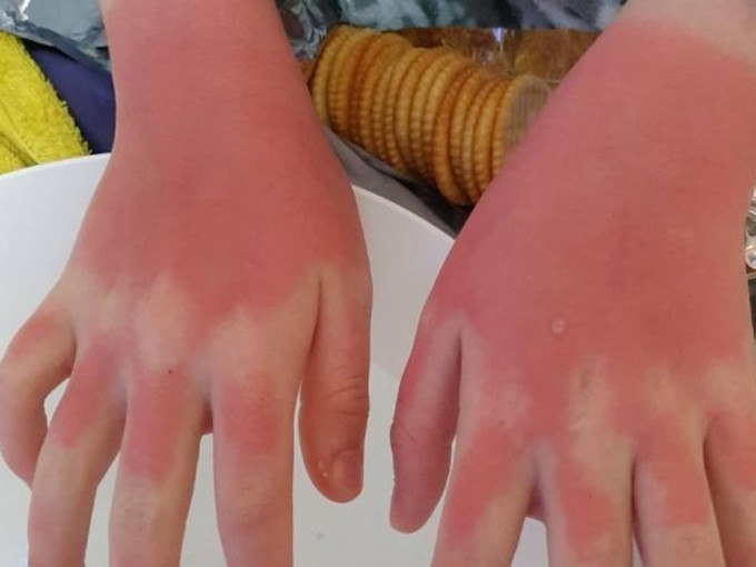 12岁女参加完学校的水上活动日后，双手被晒伤，非常红烫。