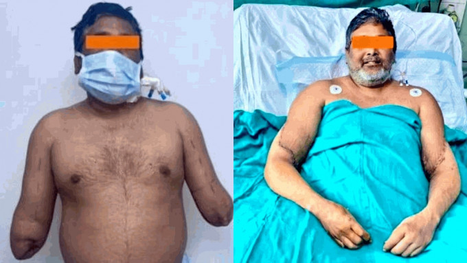 印度男画家库马尔（Raj Kumar）4年前意外撞断双手，喜获捐赠成功接上新手臂。  Sir Ganga Ram Hospital in Delhi