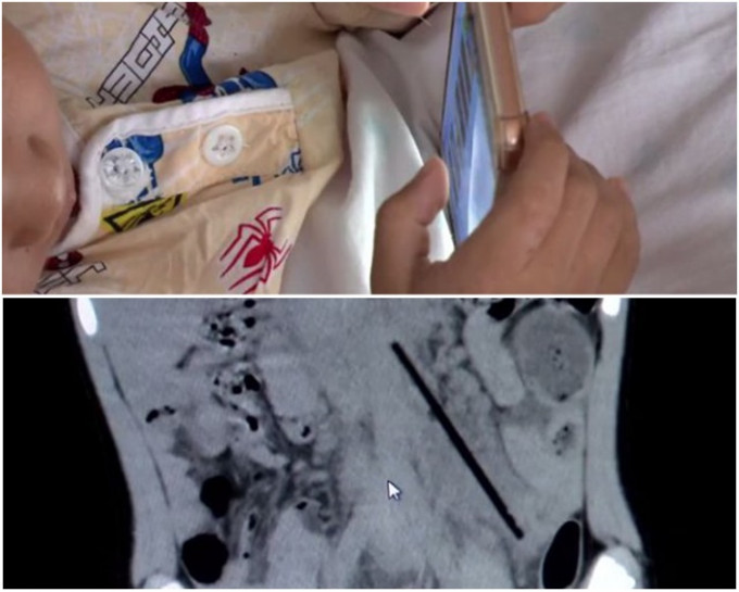 醫生用腹腔鏡找出男童病源，照出肚內有一根長達8厘米的棒棒糖棍。網圖