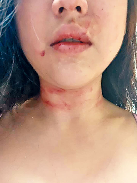 ■女事主将自拍颈部被掐血痕照片上载fb。