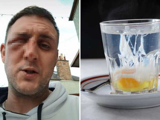 英男微波爐煮滾水蛋，食用時秒爆險毀容。網圖/資料圖片
