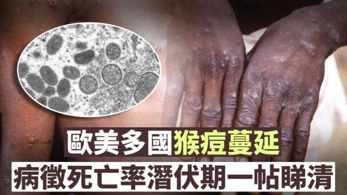 欧美多国猴痘蔓延。AP图片