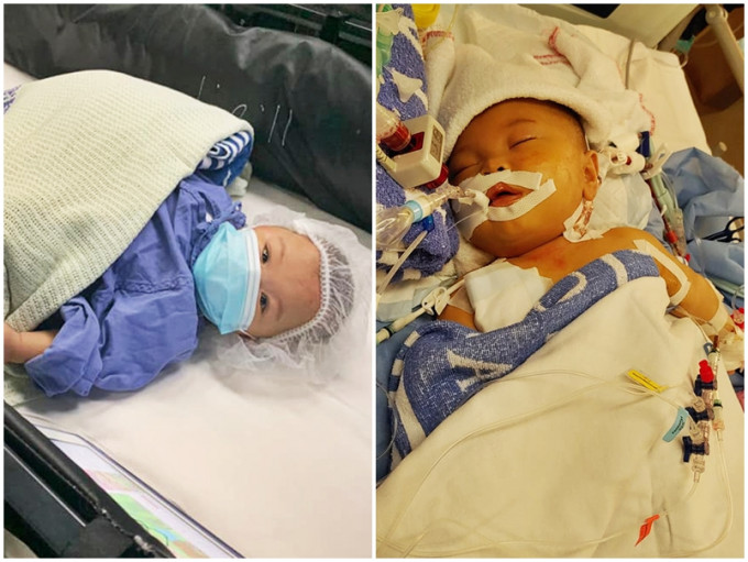 早产婴悦悦一出生便患有坏死性肠炎，至今已接受多次手术。「CoKa.Kona Baby」FB图片