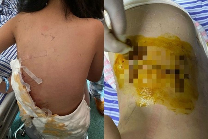 女童遭洛威拿犬咬至重傷。 網圖