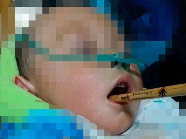 竹筷子插入男童的口腔，深入顱內。 網圖