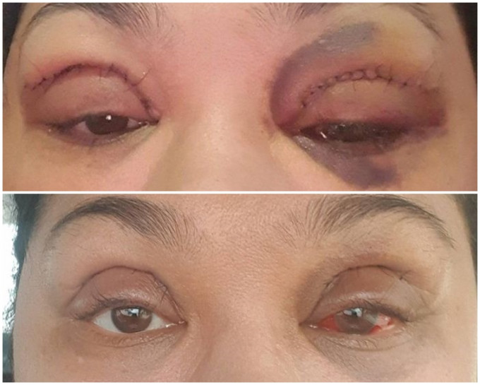 婦人割雙眼皮後，眼部紅腫而且出現瘀青，連眼球都充血變紅。網圖