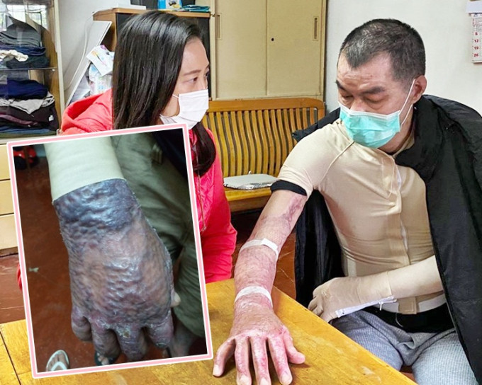 李先生的手臂不能伸直，植皮手臂肿起瘀黑。葛佩帆fb图片
