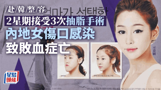 中国女子在南韩首尔接受抽脂手术　伤口感染肌肉腐烂惨死