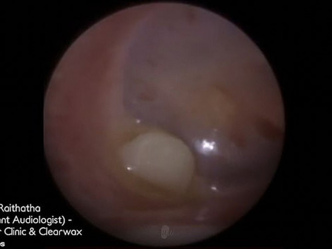 英国3岁男童感耳痛求诊，医生惊见耳内藏「乳齿」。