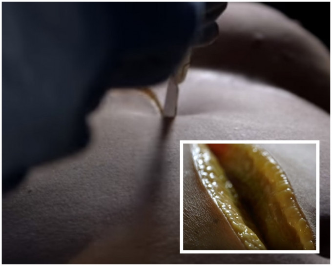 遺體在剖開胸口後，首先見到一層約3厘米厚的黃色脂肪(小圖)。片段截圖