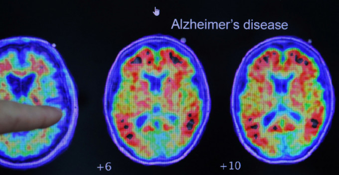 阿茲海默症是最常見的認知障礙症。路透社