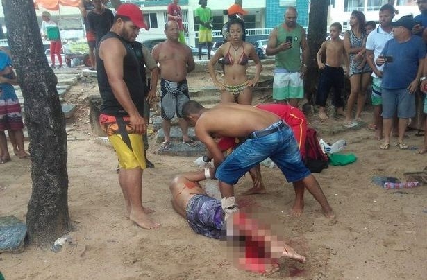 巴西男被鲨鱼攻击，右脚被咬至见骨。（网图）