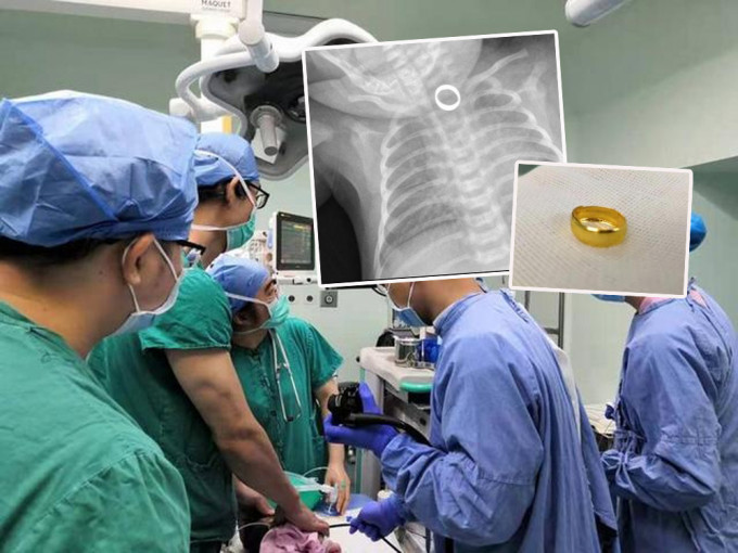 广东1岁女婴误吞金戒指卡食道，医生用超细胃镜拆弹。(网图)