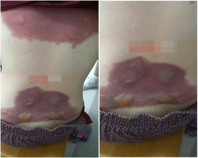 浙江一名女子用新鲜芦荟治疗腰痛，结果导致腰部发红长水泡。(网上图片)