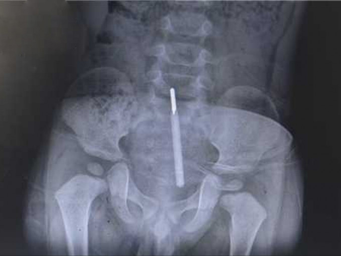 X光片顯示整枝探熱針已插入小強的直腸中。（網圖）