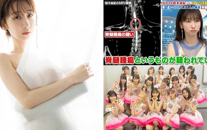AKB48成員柏木由紀去年發現患有罕見病 ，復工數月確診新冠肺炎。