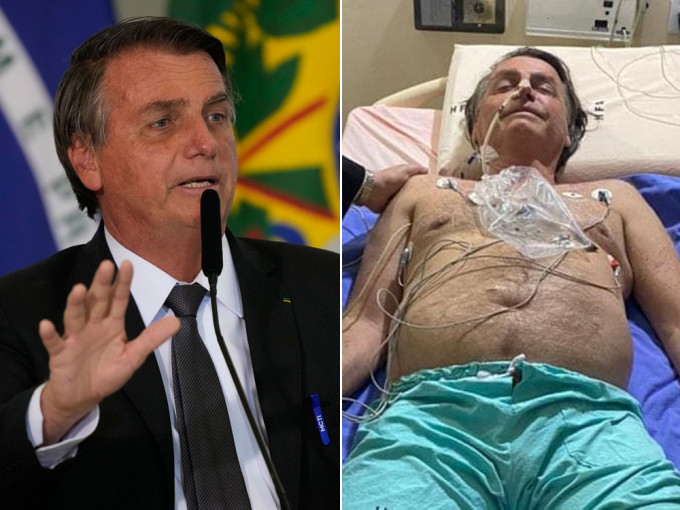巴西總統博索納羅腸阻塞有好轉，不用接受手術。AP/網圖