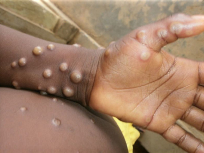 德州一名居民感染了罕见的猴痘（monkeypox）病毒。网图