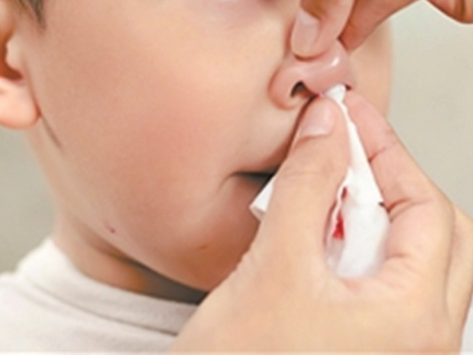 流鼻血，中醫病名為「鼻衄」，小兒較為常見。網圖（示意圖）