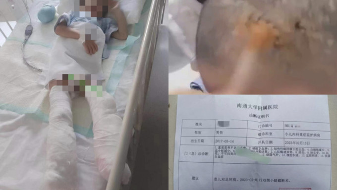 江苏5岁男童被生母虐待致截肢，官方：母亲已被批捕。