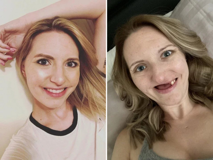 柯瓦丝姬患癌症前的照片（左），手术后拔除11颗牙齿，嘴巴只能微微张开。（网图）