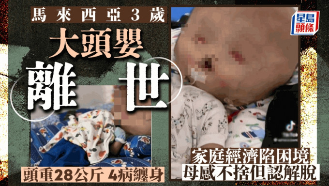 马来西亚3岁男婴莫哈末比拉患上无叶前脑无裂畸形症（Alobar Holoprosencephaly），头部重达28公斤。