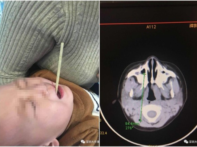 筷子从口腔直插入喉，险些贯穿孩童颈部。 网上图片