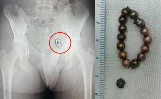 医生从X光片中发现，男童体内的巴克球已固定在膀胱左侧壁，形状就像是一个「手环」。
