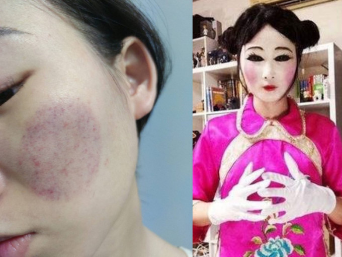 台灣女子在臉上拔罐，結果被嘲為像紙紮公仔。 （網上圖片）