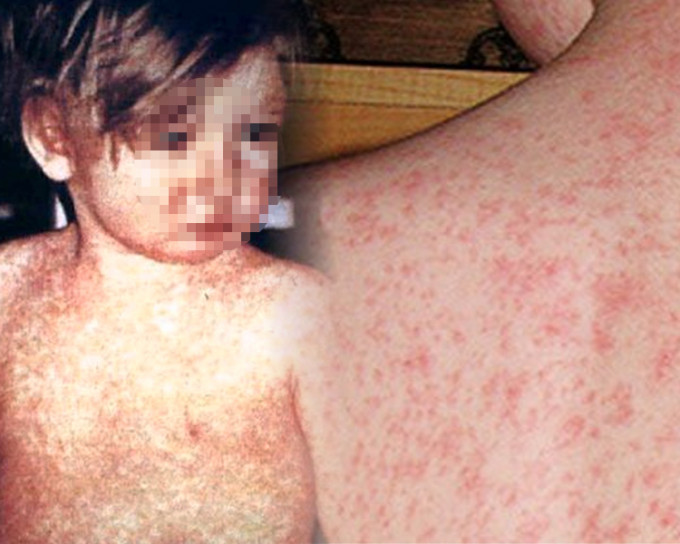 感染麻疹后两三天内立即打针，可以有效纾缓疫情。