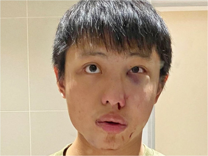 新加坡留學生莫顯強（Jonathan Mok）去年因疫情歧視遭毆打。網圖