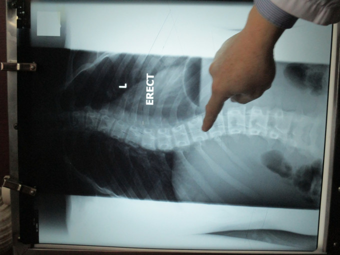 承办商于为学生进行脊柱X光检查时，未有将乳腺屏蔽装置并放置在正确位置，亦未有使用生殖腺屏蔽装置。资料图片(示意图)