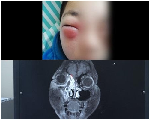 男童入院时右眼已肿得睁不开。（图上）电脑扫描显示眼鼻间的鼻窦区域灌满脓。（图下）网图