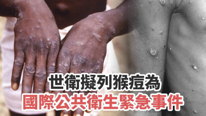 世衛計畫將猴痘列為國際公共衛生緊急事件。AP圖片
