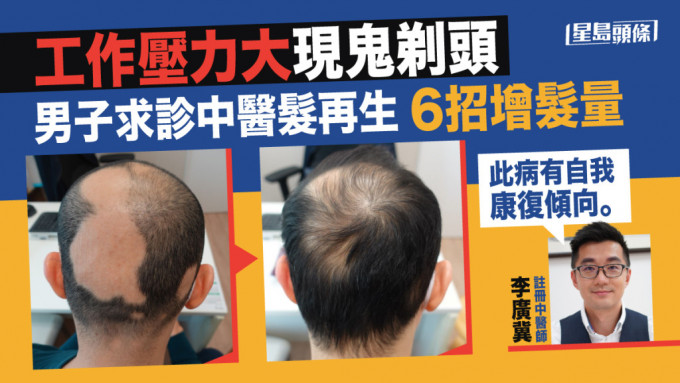 一名男子因工作压力大出现「鬼剃头」，中医分享生发方法。