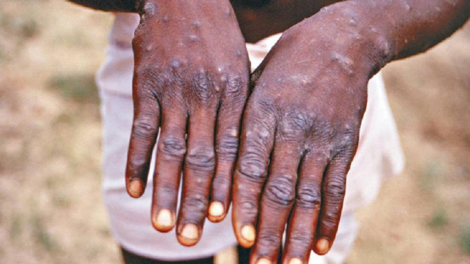 猴痘蔓延至全球至少75个国家。AP资料图片