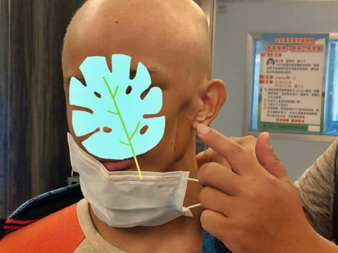 台湾一名姓许的单亲爸爸，其14岁的儿子曾经患癌，并曾3度复发，左半部牙龈及牙齿都被癌细胞啃噬，只能将左边脸削去大半才能保命。网图