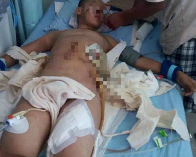 哈尔滨十四岁男童贪玩爆竹致肚破肠流，现正在医院留医。网图