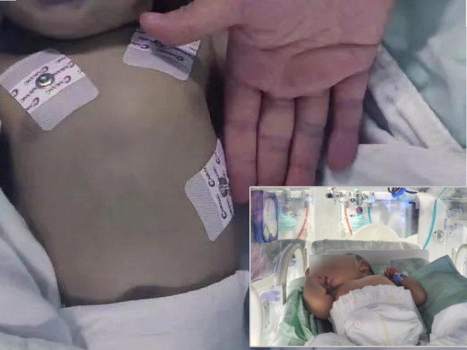 亚硝酸盐中毒的婴儿送往医院时全身发紫。（网上图片）