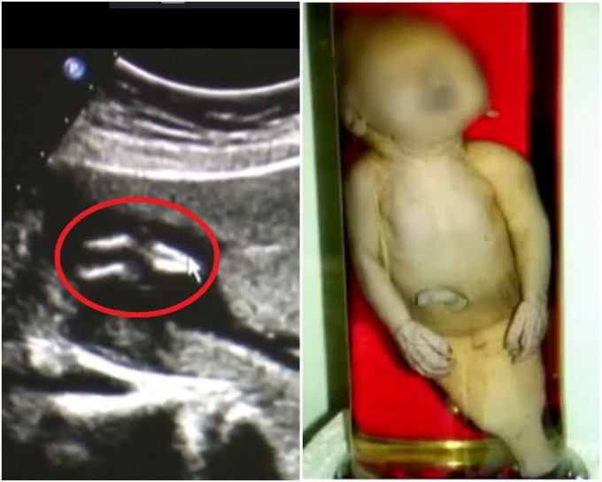 江蘇蘇州40歲陳女士的3個月胎兒被確診患上罕見的「美人魚綜合症」(左)，「美人魚綜合症」嬰兒的模樣(右)。網圖